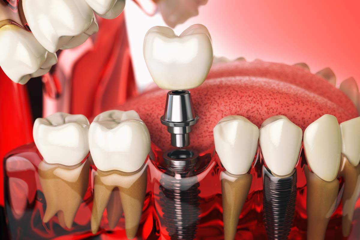 3D model showing how a dental implant can restore a tooth