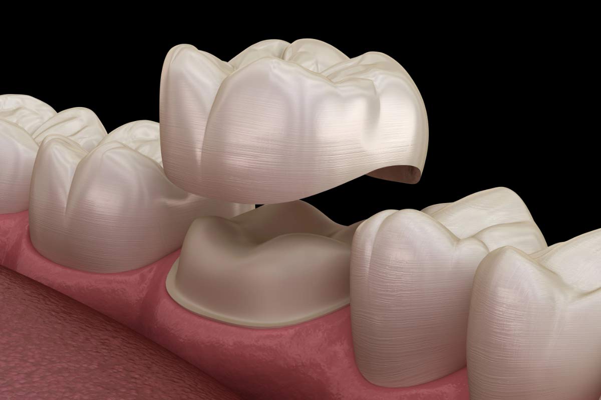 3D model of how dental crowns work